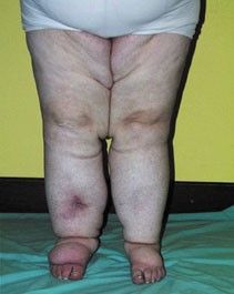 Schwere Beine - wenn die Lymphe zur Last wird