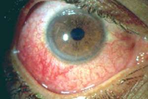 Entzündliche Augenkrankheit (Uveitis)