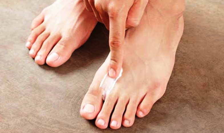 Fußpilzerkrankung besonders bei Diabetes