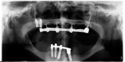 Alternative Implantationsverfahren