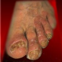 Wie bemerkt man eine Fußpilzinfektion