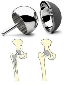 Knochenschonender Gelenkersatz für jüngere Menschen