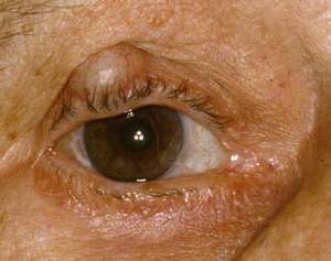 Hagelkorn (Chalazion)