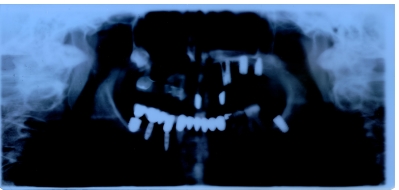 Implantate - Reicht mein Knochen aus?