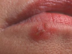 Wie man Lippenherpes erfolgreich behandeln kann