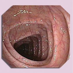 Colitis ulcerosa (chronische Dickdarmentzündung)