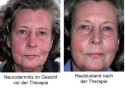 Therapie der Neurodermitis