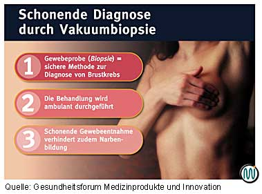 Brustkrebs - Schonende und sichere Diagnose mit der Vakuumbiopsie