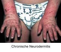 Neurodermitis / Der Neurodermitistest