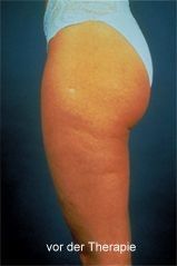 Schwere Beine - was tun gegen Orangenhaut?
