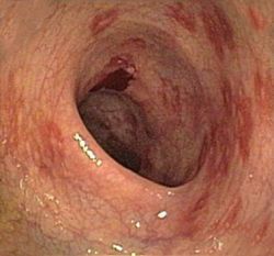 Morbus Crohn (Ileitis terminalis, Enteritis regionalis)