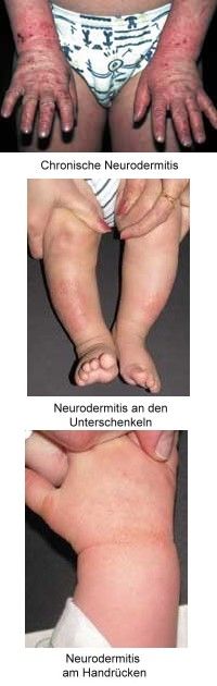 Verlauf der Neurodermitis