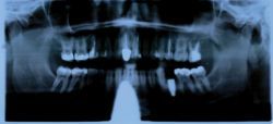 Sofortimplantate - Der schnelle Weg zu neuen Zähnen