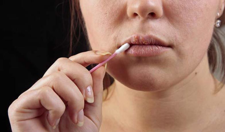 Erfolgreiche Behandlung von Lippenherpes Erfolgreiche Behandlung von Lippenherpes