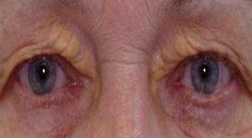 Was ist Xanthelasma