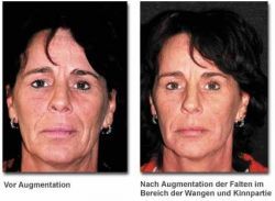 Anti-Aging - Was tun gegen Falten?