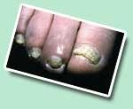 Hautinfektionen und Folgeerkrankungen durch Fußpilz