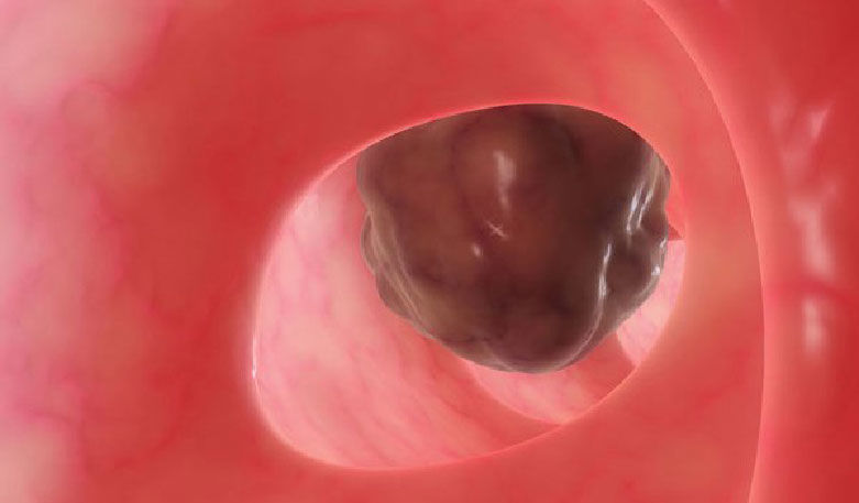 Diagnose Magenkrebs (Magenkarzinom)-wie geht es weiter