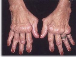 Die rheumatoide Gelenkentzündung (Arthritis)