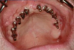 Implantat – Festsitzende Zähne Teil 1