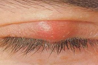 Gerstenkorn - Entzündung am Auge