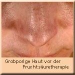 Anti-Aging - Fruchtsäuretherapie