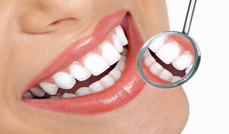 Schöne Zähne durch Bleaching (Zahnaufhellung)