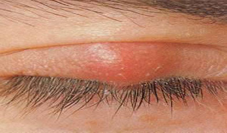 Inflammation of the eyelid gland in the eye|stye|hordeolum