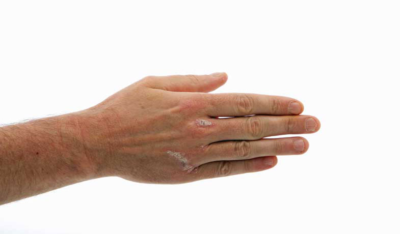 Flecken handfläche weiße Weiße Pigmentflecken