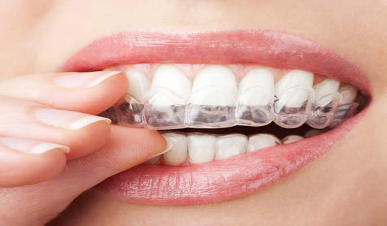 Zähneknirschen: Wenn Zähne die Sorgen mahlen
